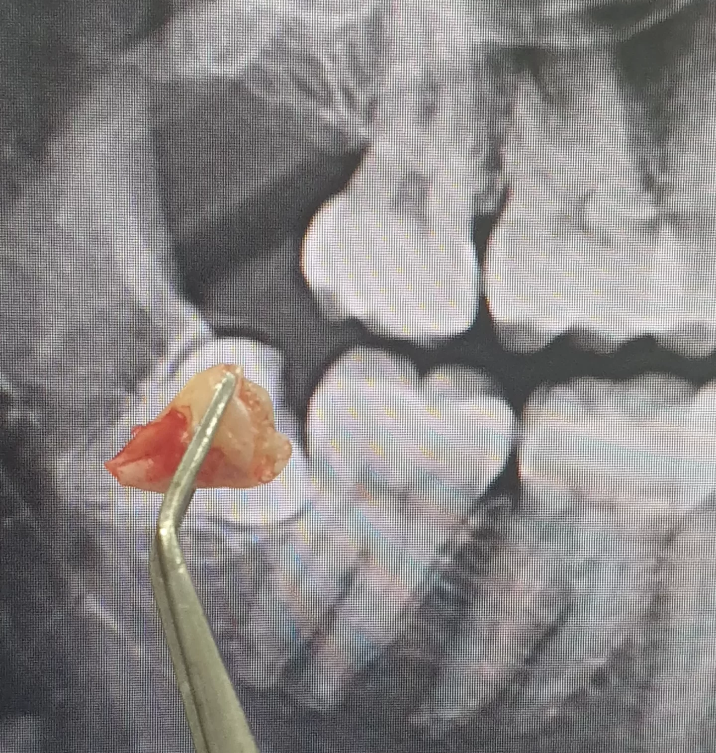 Wisdom Tooth Removal Before & After | EasyCare Woolloongabba Before and after wisdom tooth removal – EasyCare Family Dental Woolloongabba