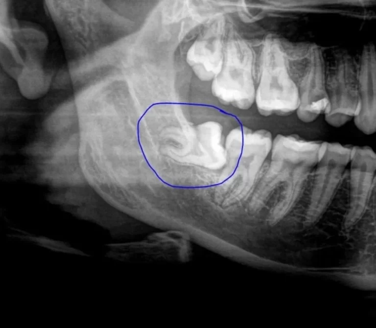 Wisdom Teeth removal