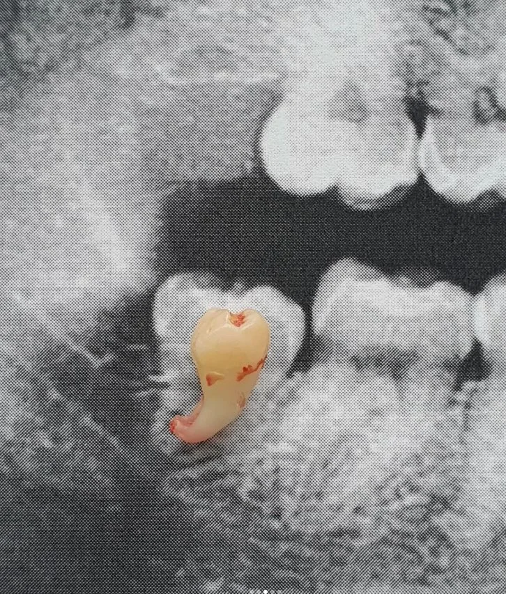 Wisdom Teeth extraction