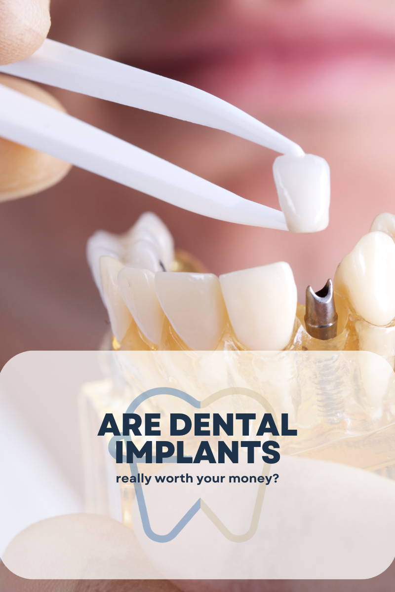 Are dental implants worth it guide