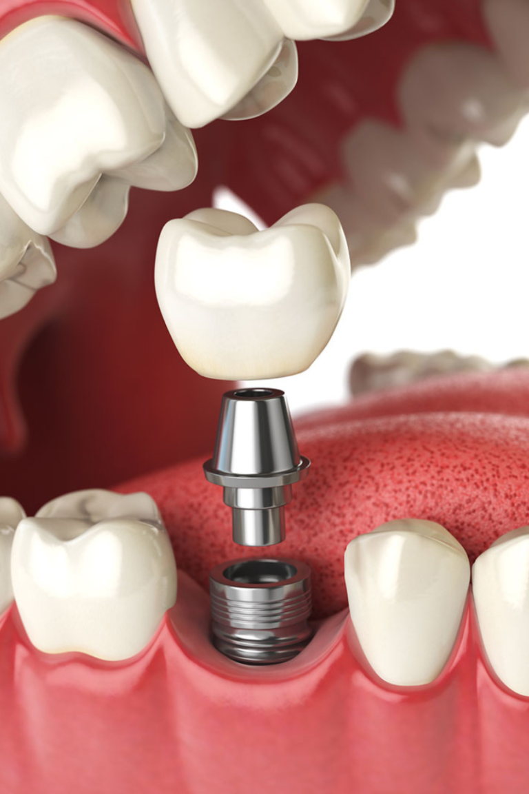 implant before and after image at EasyCare Dental East Brisbane