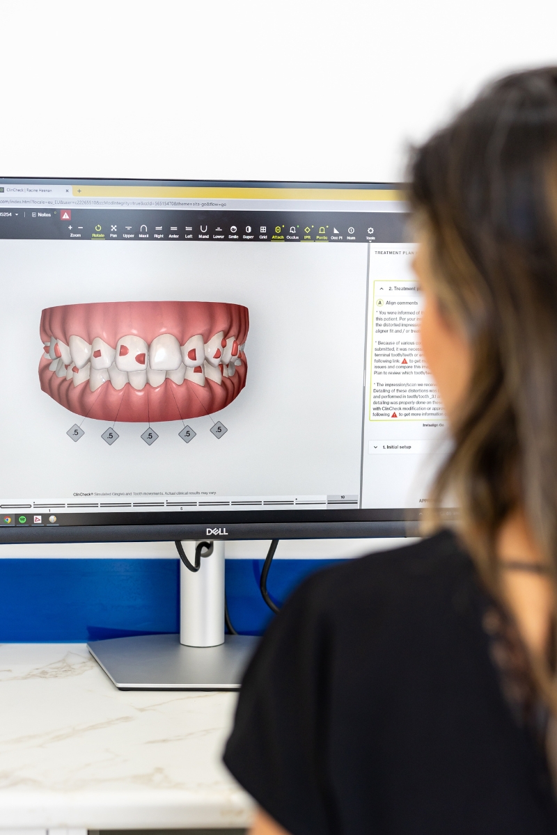 Invisalign digital smile design preview