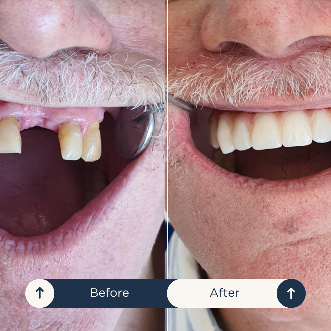 Illustration of implant and crown demonstrating natural-looking results