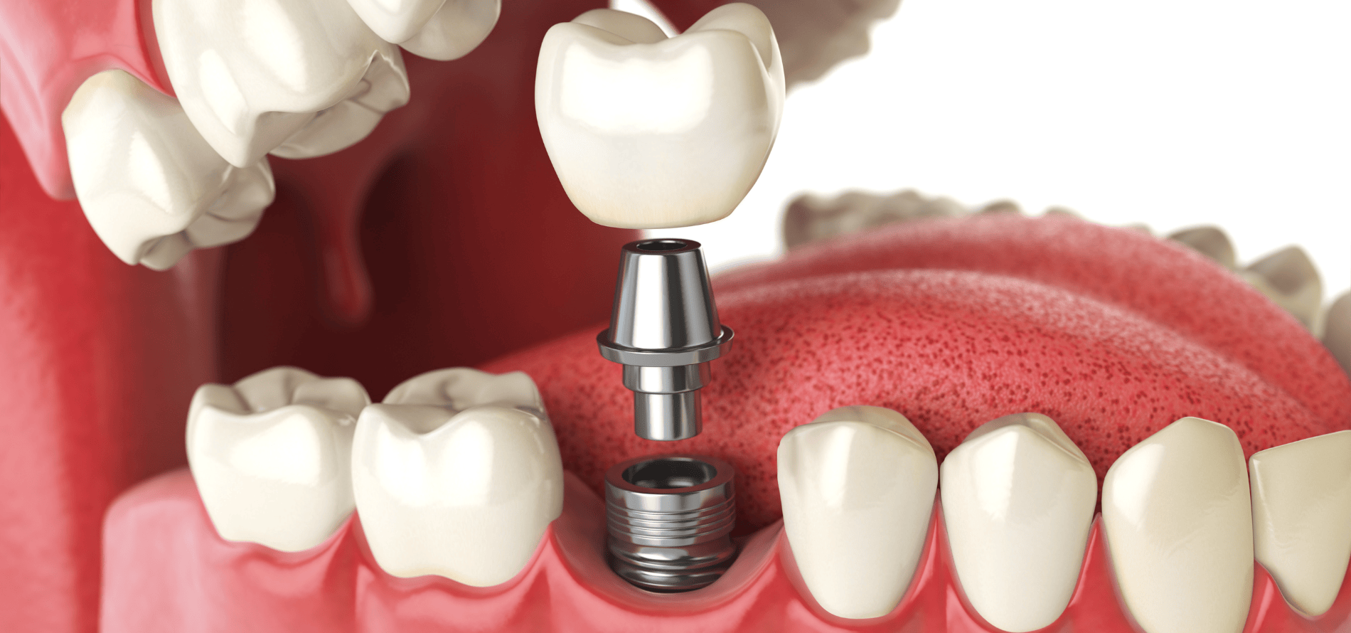 Dental implants safety and planning diagram - EasyCare Family Dental East Brisbane and Kangaroo Point