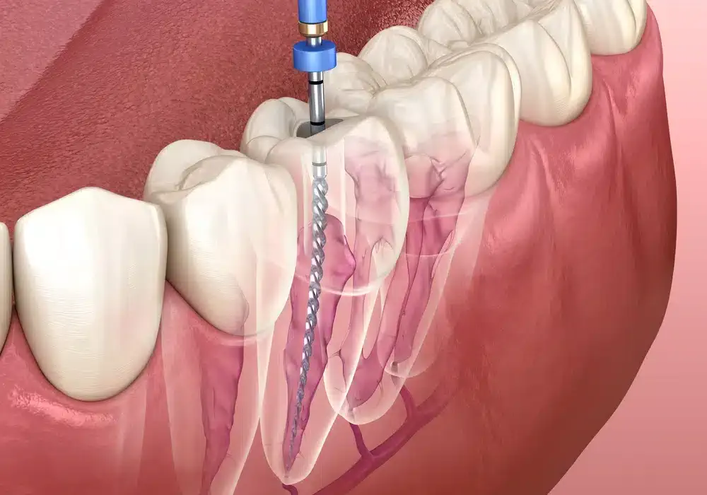 root canal diagram