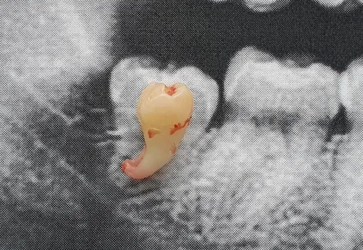 tooth-extracted sitting on an x-ray