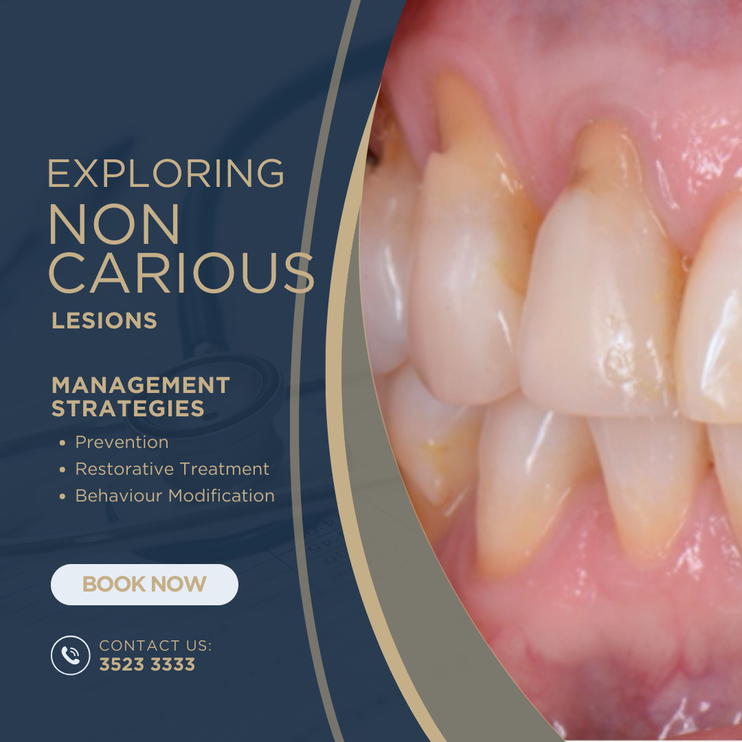 Diagram of non-carious tooth wear: abrasion, erosion, attrition and abfraction
