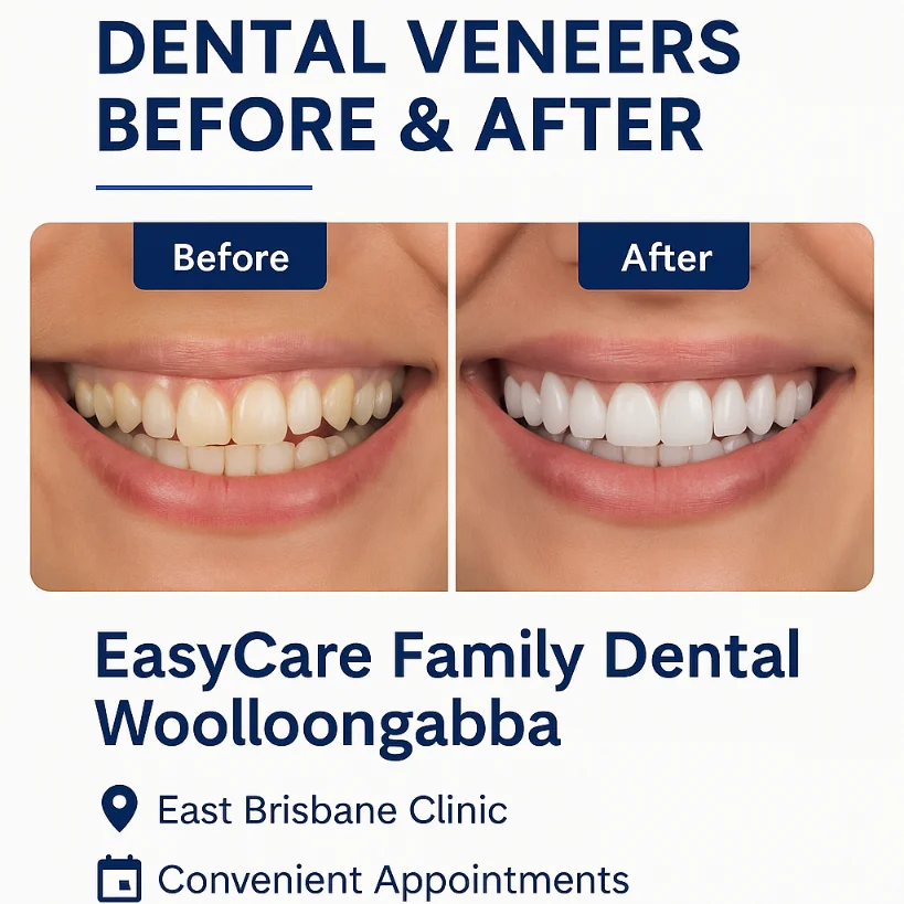 Dental Veneers Before & After | EasyCare Woolloongabba Before and after dental veneers result – EasyCare Family Dental Woolloongabba