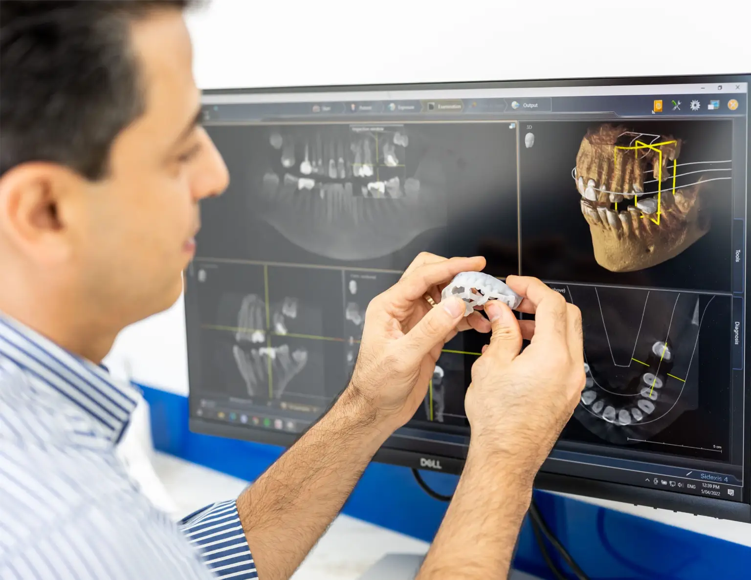 3D printed surgical guide for precise implant placement