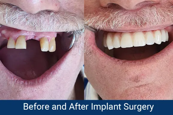 Dental implant before and after