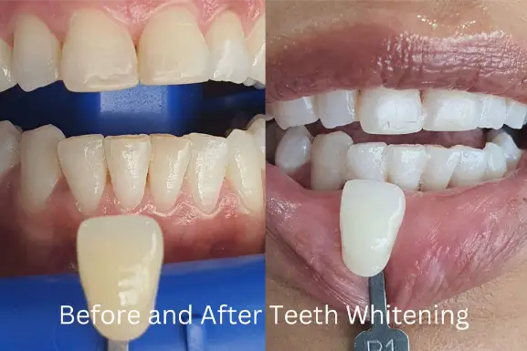 Teeth whitening before and after