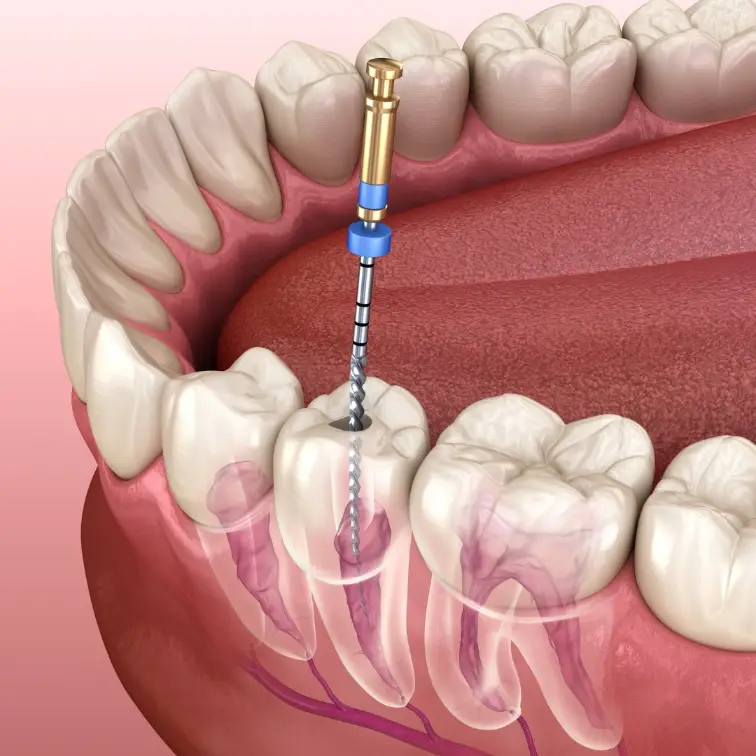 Root canal therapy to save teeth