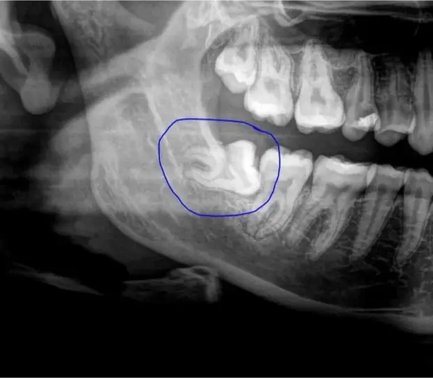 Wisdom teeth removal