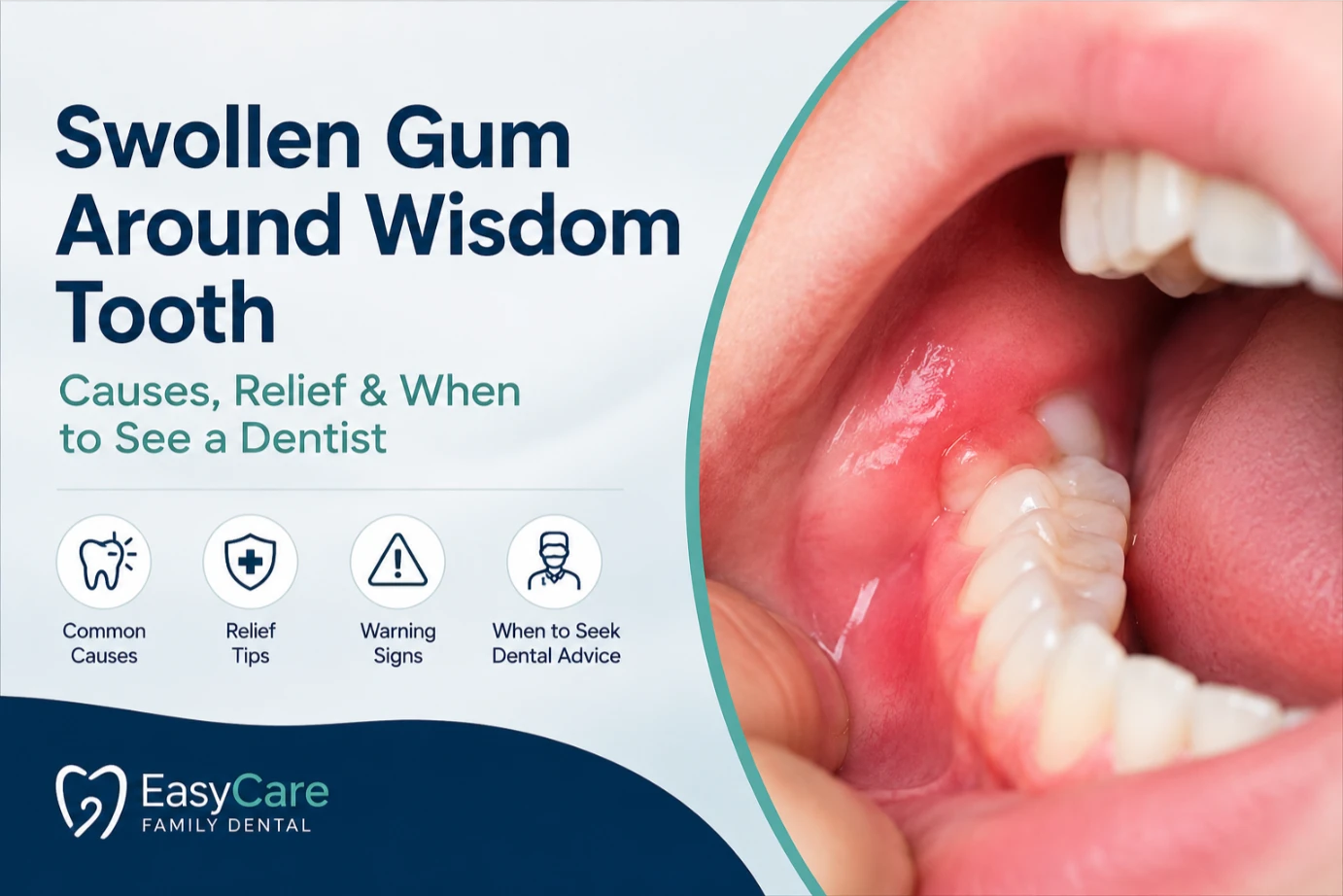 Educational guide image for swollen gum around a wisdom tooth